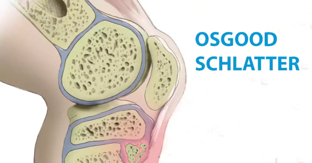 Osgood Schlatter Surgery Everything You Need To Know Learning Physio Osgood Schlatter Surgery Everything You Need To Know Learning Physio