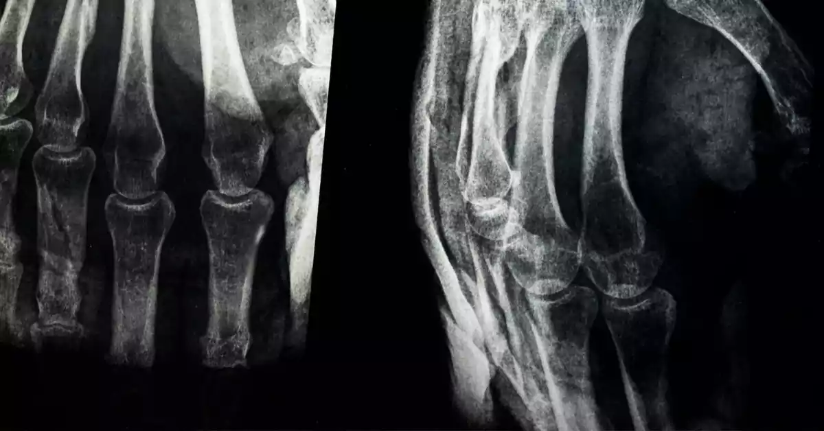 What Are Hairline Fractures? Causes, Symptoms, Prevention, Risk Factors